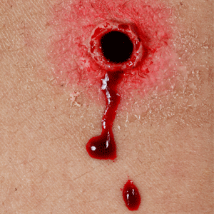 gunshot wound wounds